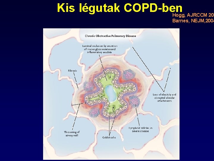 Kis légutak COPD-ben Hogg, AJRCCM 200 Barnes, NEJM, 2004 