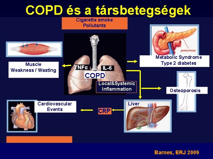 COPD és a társbetegségek Cigarette smoke Pollutants Muscle Weakness / Wasting TNFα Metabolic Syndrome