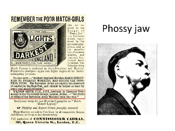 Phossy jaw 