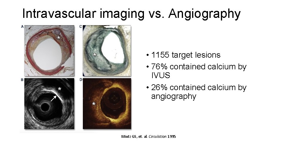 Intravascular imaging vs. Angiography • 1155 target lesions • 76% contained calcium by IVUS