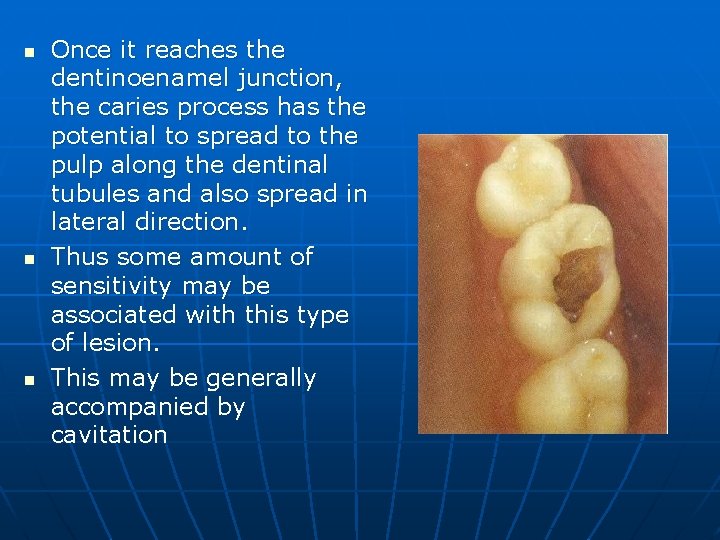 n n n Once it reaches the dentinoenamel junction, the caries process has the