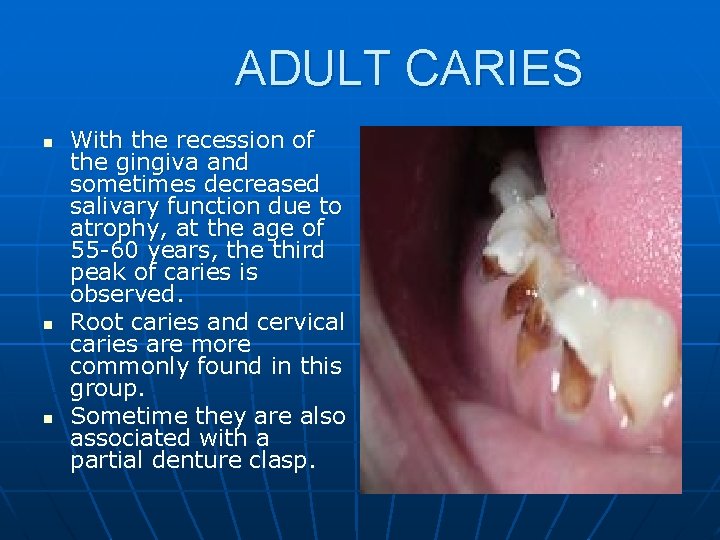 ADULT CARIES n n n With the recession of the gingiva and sometimes decreased