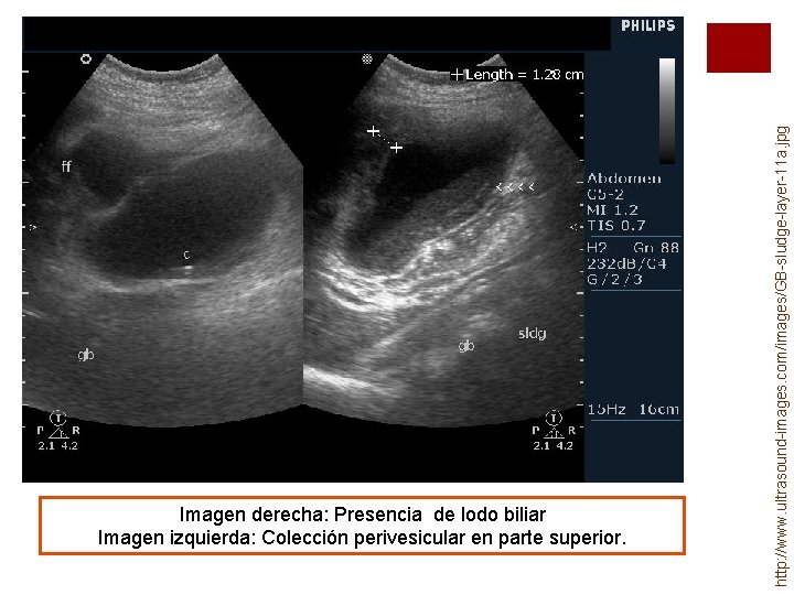 http: //www. ultrasound-images. com/images/GB-sludge-layer-11 a. jpg Imagen derecha: Presencia de lodo biliar Imagen izquierda: http: //www. ultrasound-images. com/images/GB-sludge-layer-11 a. jpg Imagen derecha: Presencia de lodo biliar Imagen izquierda: