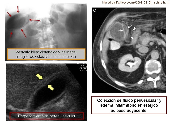http: //drgallifa. blogspot. mx/2008_09_01_archive. html Vesícula biliar distendida y delinada, imagen de colecistitis enfisematosa http: //drgallifa. blogspot. mx/2008_09_01_archive. html Vesícula biliar distendida y delinada, imagen de colecistitis enfisematosa