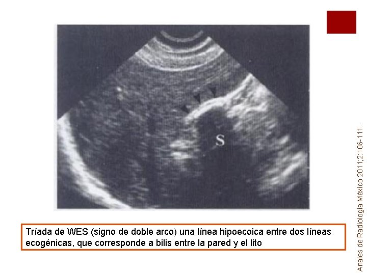 Anales de Radiología México 2011; 2: 106 -111. Tríada de WES (signo de doble Anales de Radiología México 2011; 2: 106 -111. Tríada de WES (signo de doble