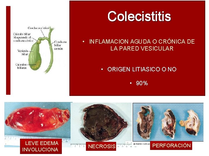 Colecistitis • INFLAMACION AGUDA O CRÓNICA DE LA PARED VESICULAR • ORIGEN LITIASICO O Colecistitis • INFLAMACION AGUDA O CRÓNICA DE LA PARED VESICULAR • ORIGEN LITIASICO O