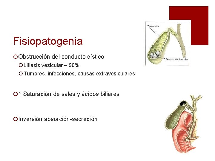 Fisiopatogenia ¡Obstrucción del conducto cístico ¡ Litiasis vesicular – 90% ¡ Tumores, infecciones, causas Fisiopatogenia ¡Obstrucción del conducto cístico ¡ Litiasis vesicular – 90% ¡ Tumores, infecciones, causas