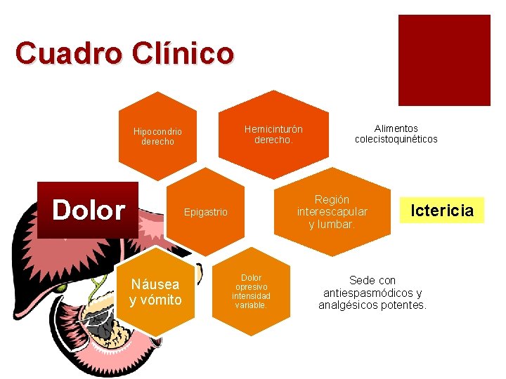 Cuadro Clínico Hemicinturón derecho. Hipocondrio derecho Dolor Región interescapular y lumbar. Epigastrio Náusea y Cuadro Clínico Hemicinturón derecho. Hipocondrio derecho Dolor Región interescapular y lumbar. Epigastrio Náusea y