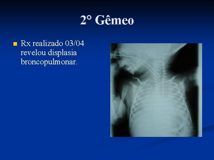 2° Gêmeo Rx realizado 03/04 revelou displasia broncopulmonar. 