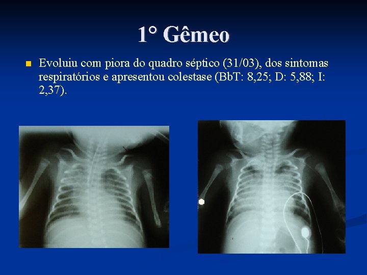 1° Gêmeo Evoluiu com piora do quadro séptico (31/03), dos sintomas respiratórios e apresentou