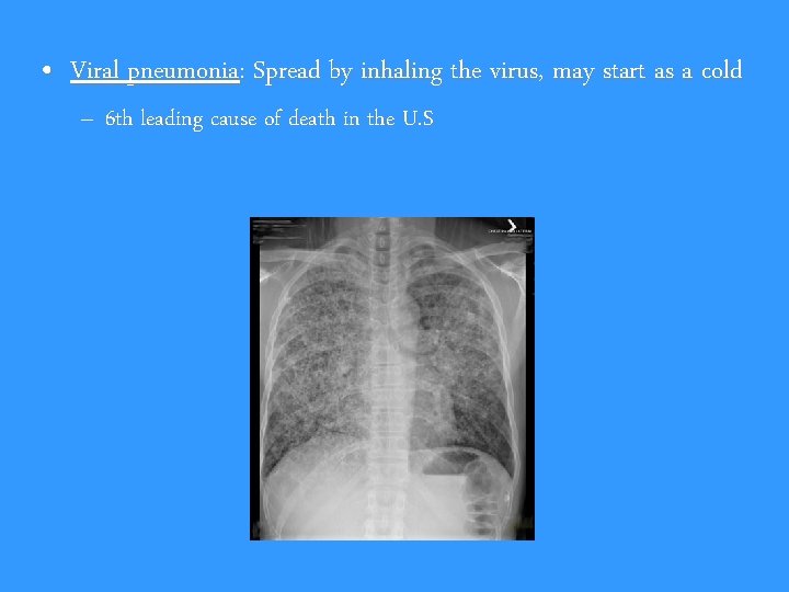  • Viral pneumonia: Spread by inhaling the virus, may start as a cold