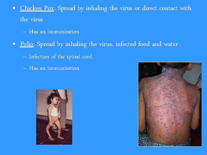  • Chicken Pox: Spread by inhaling the virus or direct contact with the