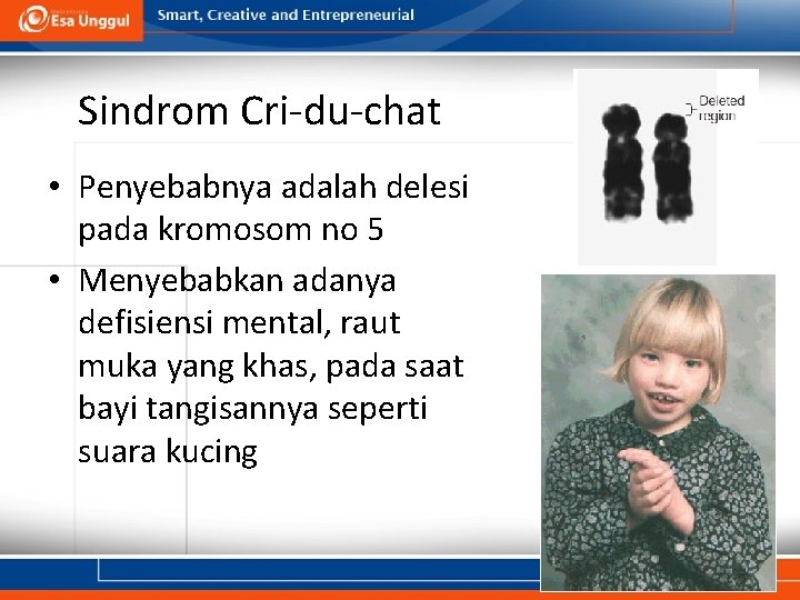 Sindrom Cri-du-chat • Penyebabnya adalah delesi pada kromosom no 5 • Menyebabkan adanya defisiensi