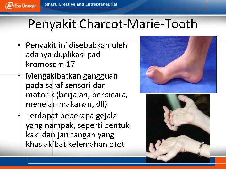 Penyakit Charcot-Marie-Tooth • Penyakit ini disebabkan oleh adanya duplikasi pad kromosom 17 • Mengakibatkan