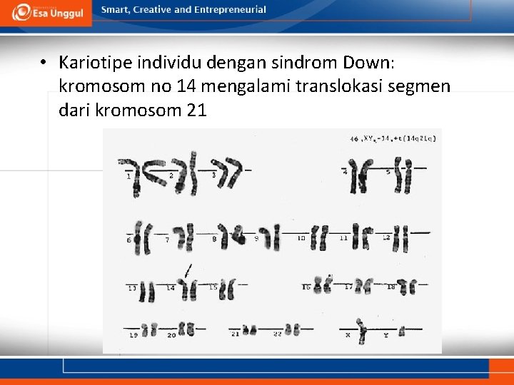  • Kariotipe individu dengan sindrom Down: kromosom no 14 mengalami translokasi segmen dari
