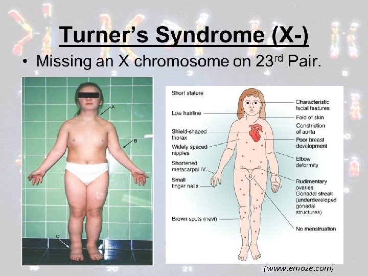 Sindrom Turner • Terjadi karena kekurangan kromosom X • Individu adalah wanita • Mengalami