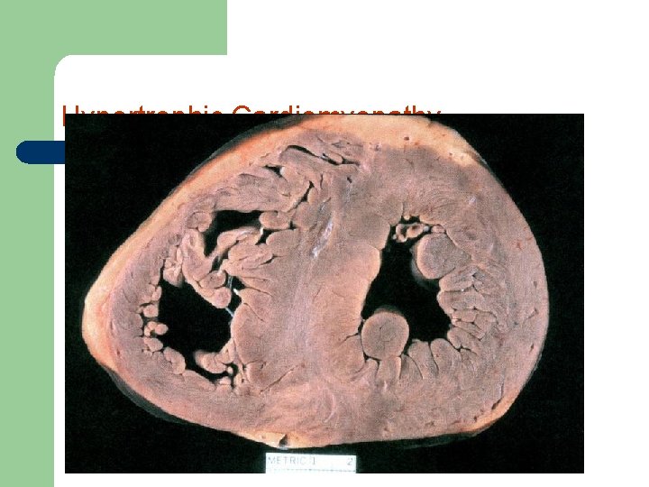 Hypertrophic Cardiomyopathy 