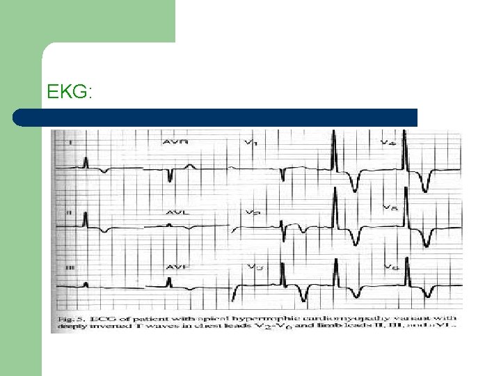 EKG: 