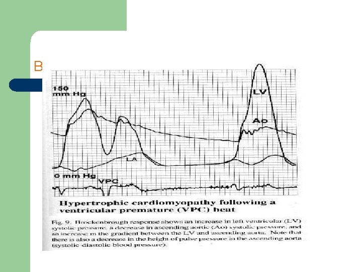 Brockenbrough response 