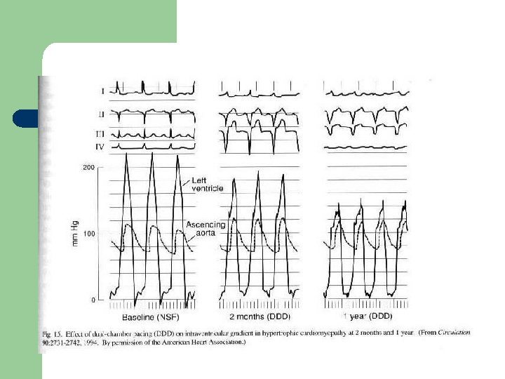 Effect of DDD pacemaker in HCM 