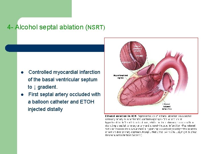 4 - Alcohol septal ablation (NSRT) l l Controlled myocardial infarction of the basal