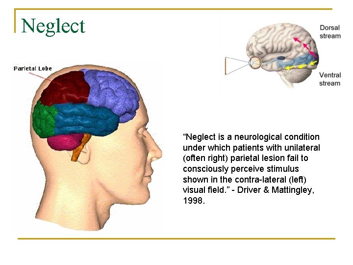 Neglect “Neglect is a neurological condition under which patients with unilateral (often right) parietal