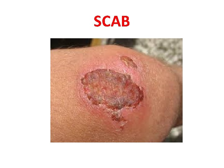 SCAB 