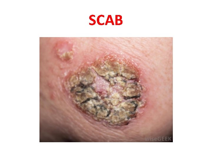 SCAB 