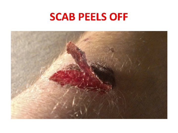 SCAB PEELS OFF 