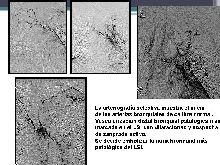 La arteriografía selectiva muestra el inicio de las arterias bronquiales de calibre normal. Vascularización