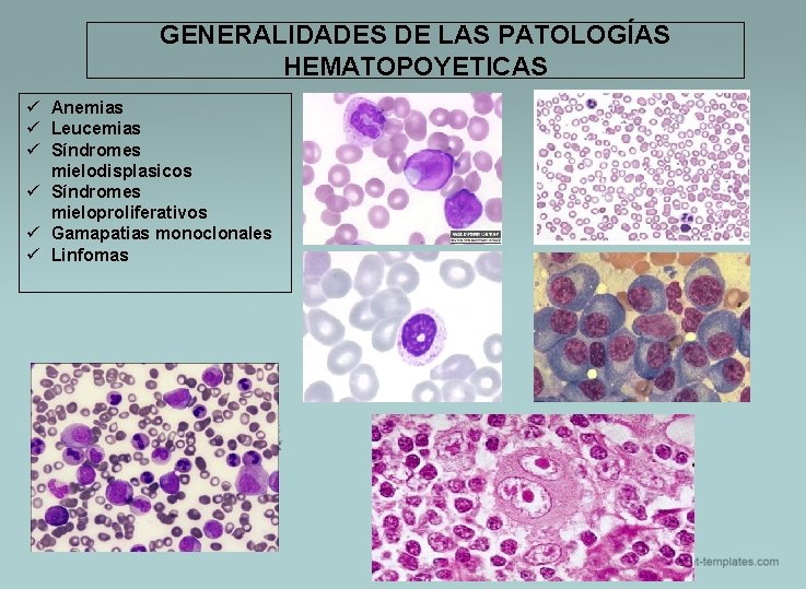 GENERALIDADES DE LAS PATOLOGÍAS HEMATOPOYETICAS ü Anemias ü Leucemias ü Síndromes mielodisplasicos ü Síndromes