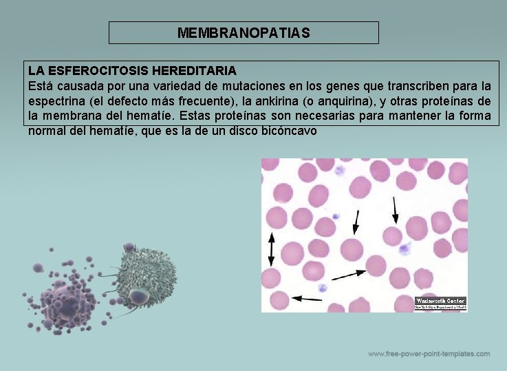 MEMBRANOPATIAS LA ESFEROCITOSIS HEREDITARIA Está causada por una variedad de mutaciones en los genes