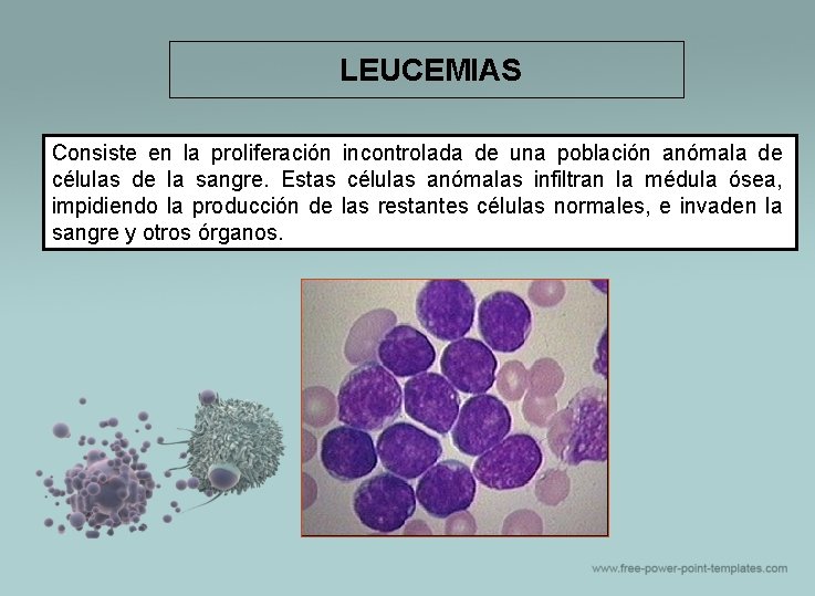 LEUCEMIAS Consiste en la proliferación incontrolada de una población anómala de células de la