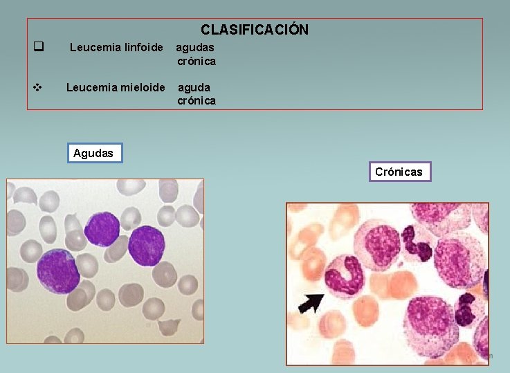 CLASIFICACIÓN q Leucemia linfoide agudas crónica v Leucemia mieloide aguda crónica Agudas Crónicas 