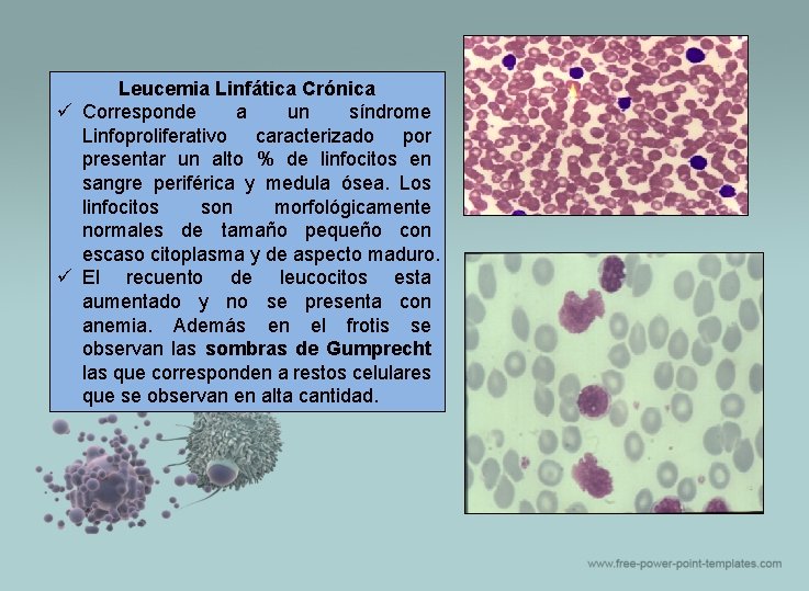 Leucemia Linfática Crónica ü Corresponde a un síndrome Linfoproliferativo caracterizado por presentar un alto
