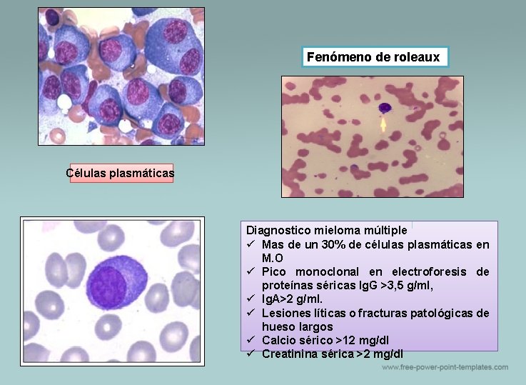 Fenómeno de roleaux Células plasmáticas Diagnostico mieloma múltiple ü Mas de un 30% de