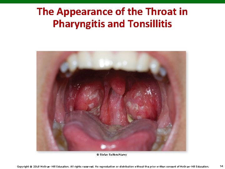 The Appearance of the Throat in Pharyngitis and Tonsillitis © Stefan Sollfors/Alamy Copyright ©