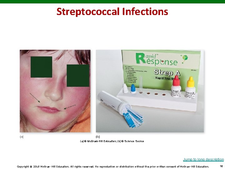 Streptococcal Infections (a) © Mc. Graw-Hill Education; (b) © Science Source Jump to long