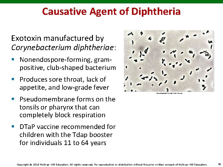 Causative Agent of Diphtheria Exotoxin manufactured by Corynebacterium diphtheriae: § Nonendospore-forming, grampositive, club-shaped bacterium