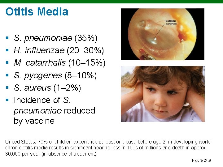 Otitis Media § § § S. pneumoniae (35%) H. influenzae (20– 30%) M. catarrhalis