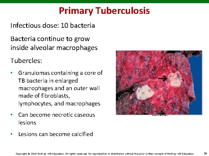 Primary Tuberculosis Infectious dose: 10 bacteria Bacteria continue to grow inside alveolar macrophages Tubercles: