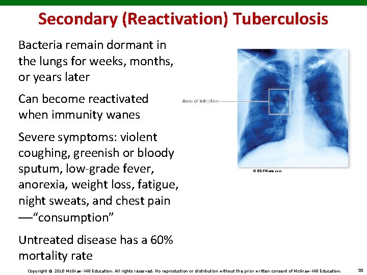 Secondary (Reactivation) Tuberculosis Bacteria remain dormant in the lungs for weeks, months, or years