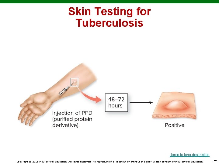 Skin Testing for Tuberculosis Jump to long description Copyright © 2018 Mc. Graw-Hill Education.