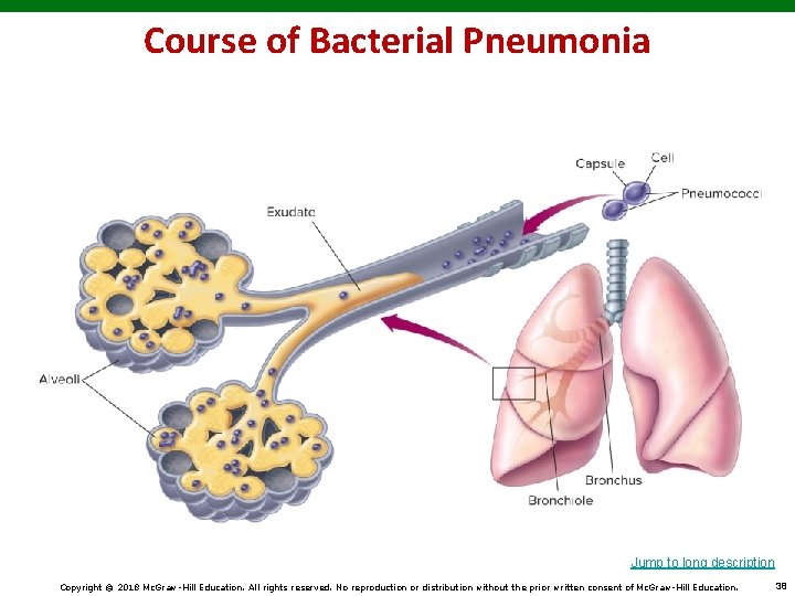 Course of Bacterial Pneumonia Jump to long description Copyright © 2018 Mc. Graw-Hill Education.
