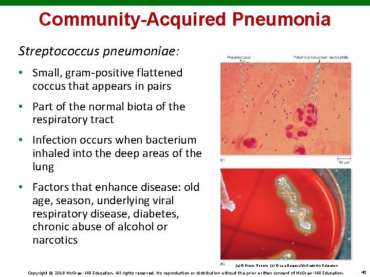 Community-Acquired Pneumonia Streptococcus pneumoniae: • Small, gram-positive flattened coccus that appears in pairs •