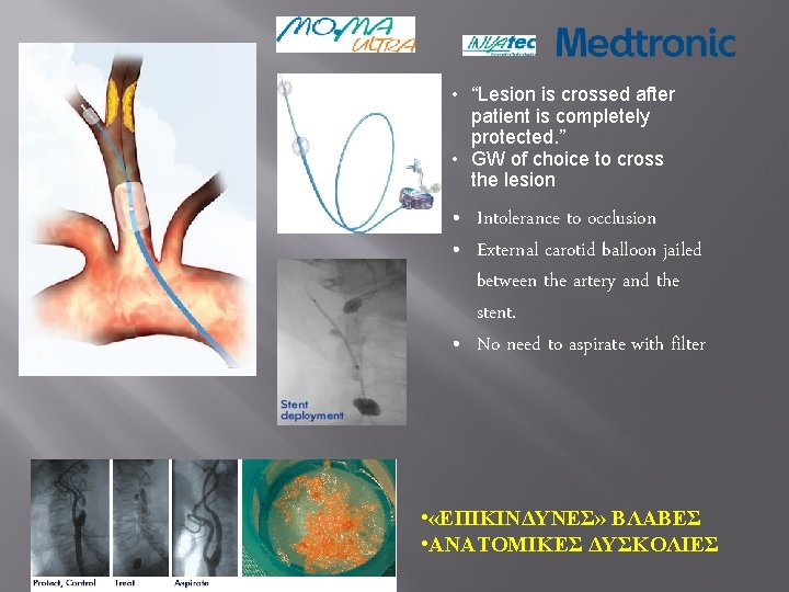  • “Lesion is crossed after patient is completely protected. ” • GW of