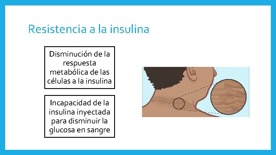 Resistencia a la insulina Disminución de la respuesta metabólica de las células a la