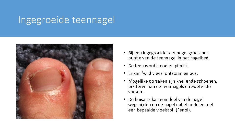 Ingegroeide teennagel • Bij een ingegroeide teennagel groeit het puntje van de teennagel in