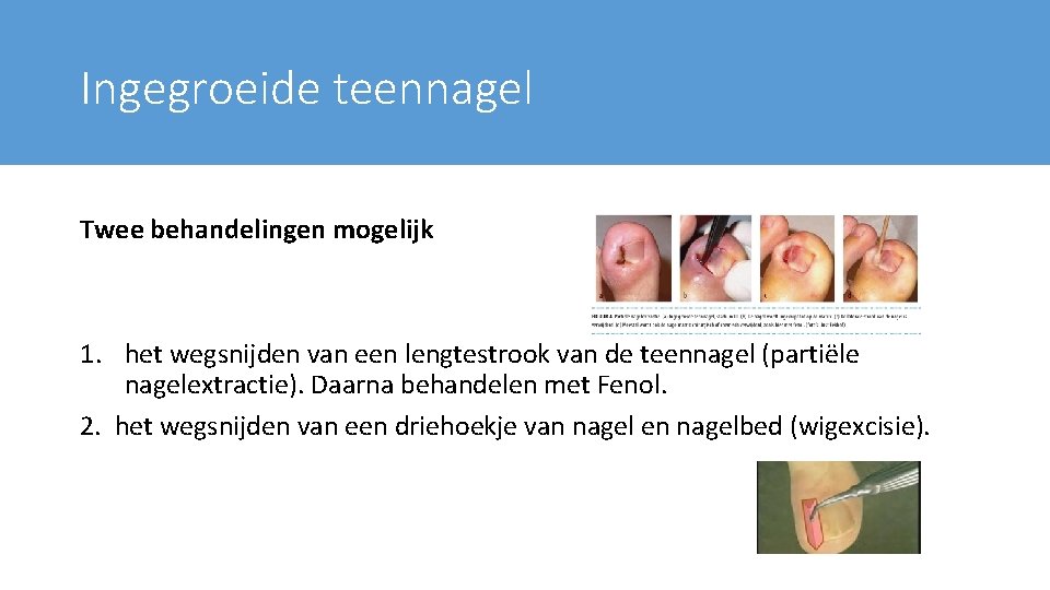 Ingegroeide teennagel Twee behandelingen mogelijk 1. het wegsnijden van een lengtestrook van de teennagel