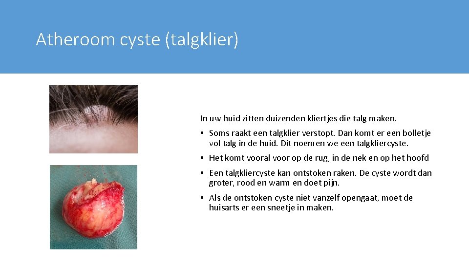 Atheroom cyste (talgklier) In uw huid zitten duizenden kliertjes die talg maken. • Soms